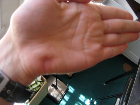 My left palm, six weeks later
