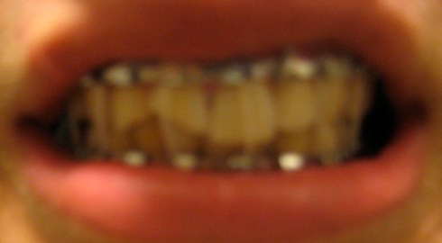 My mouth, six weeks later