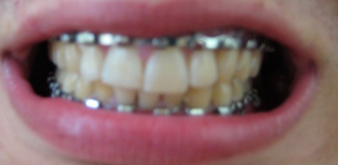 Repaired teeth